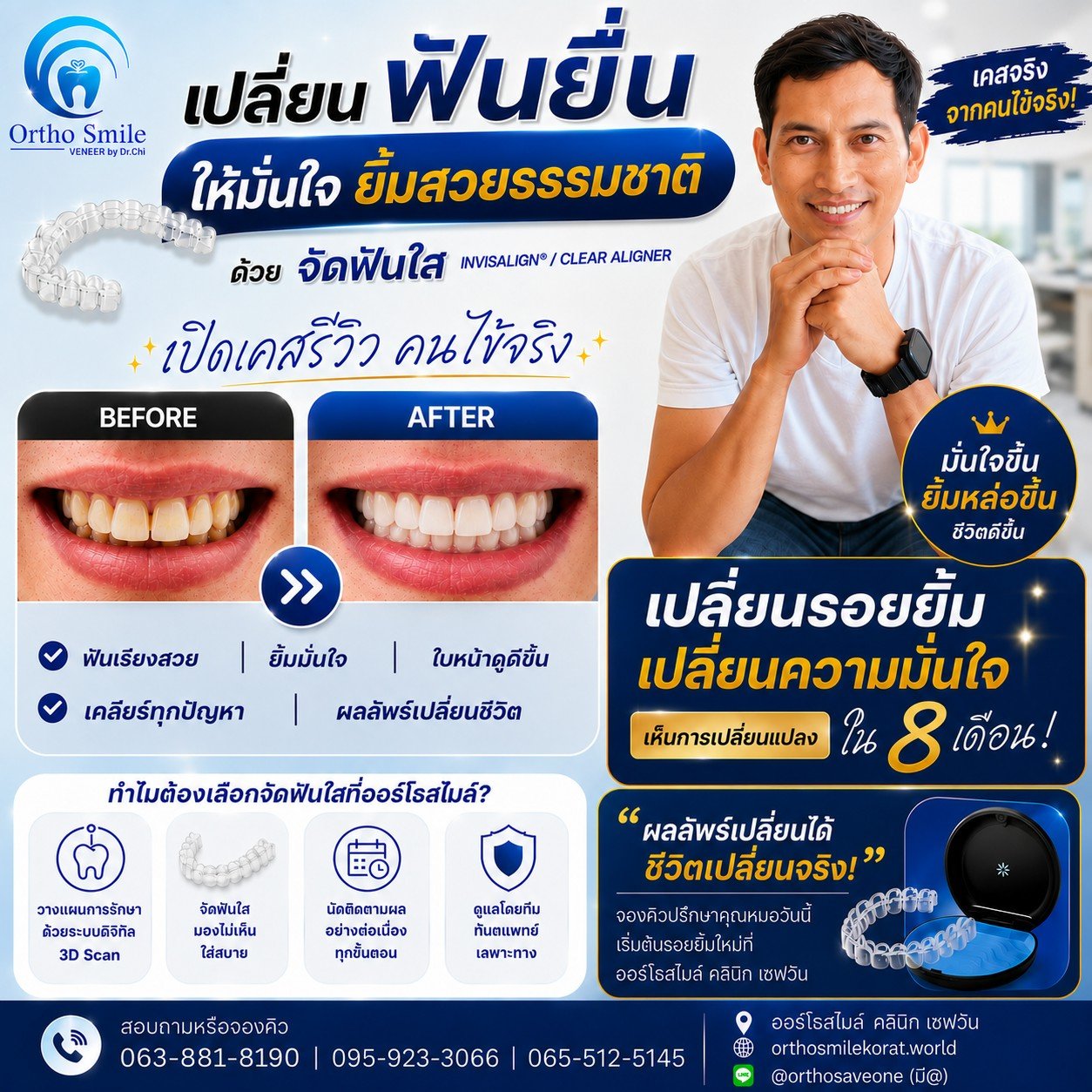 จัดฟันใส (Clear Aligner) ที่ออร์โธสไมล์ คลินิก เซฟวัน โคราช