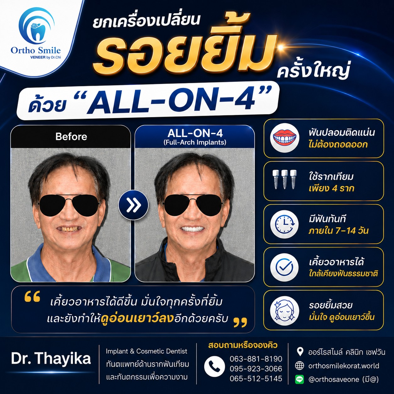 รากฟันเทียม All-on-4 คืออะไร เหมาะกับใคร