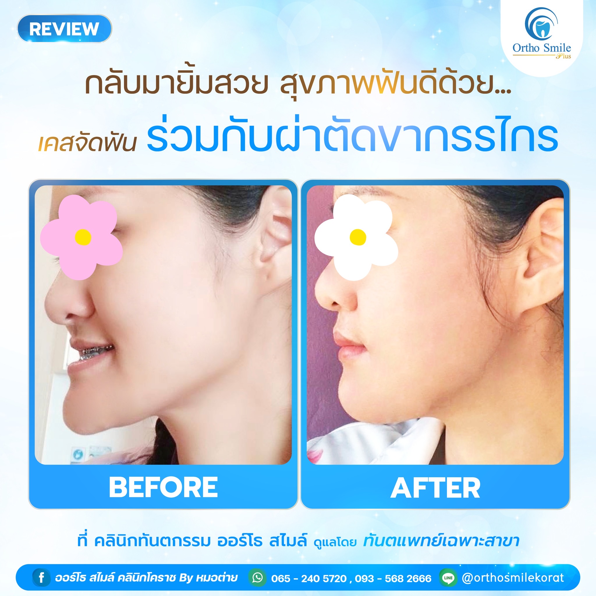 ผลงานจัดฟันเหล็ก ออร์โธสไมล์ คลินิก เซฟวัน