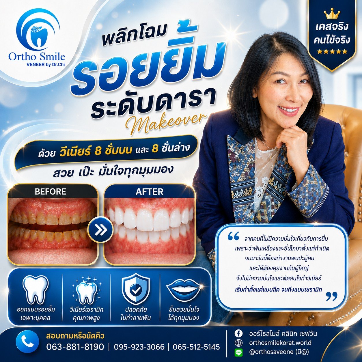 วีเนียร์ (Veneers) — ออร์โธสไมล์ คลินิก เซฟวัน โคราช